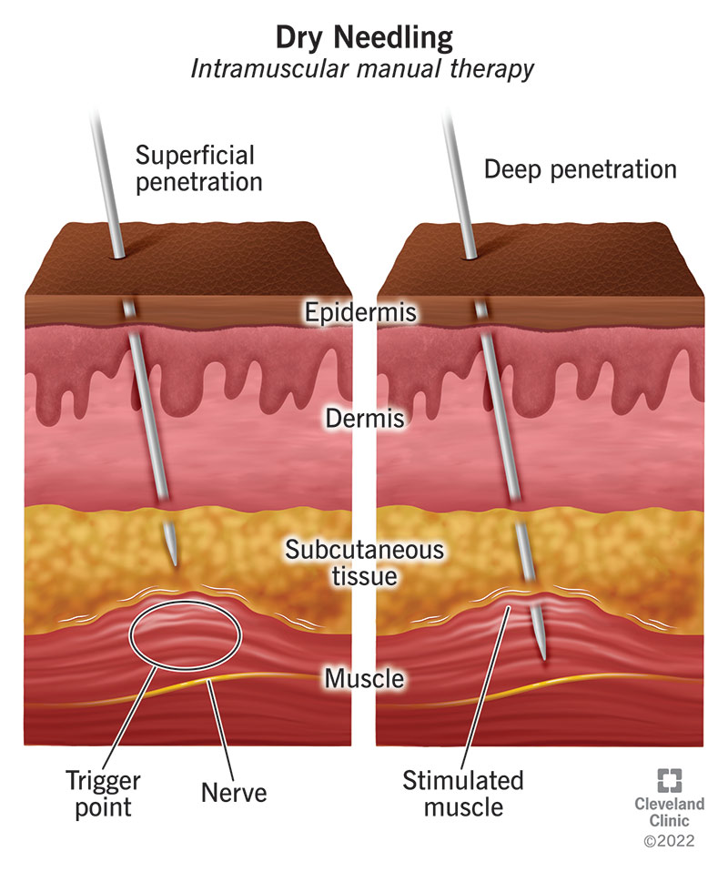 dry needling treatment performed by physical therapist
