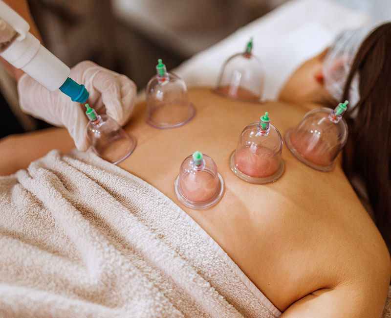 cupping therapy treatment for muscle tension relief

