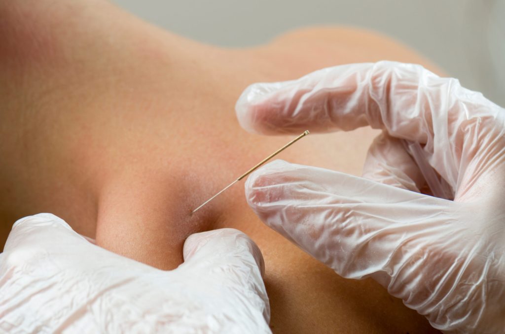 dry needling treatment for muscle pain relief