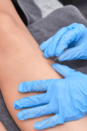 PT performing dry needling on patient’s shoulder in clinic