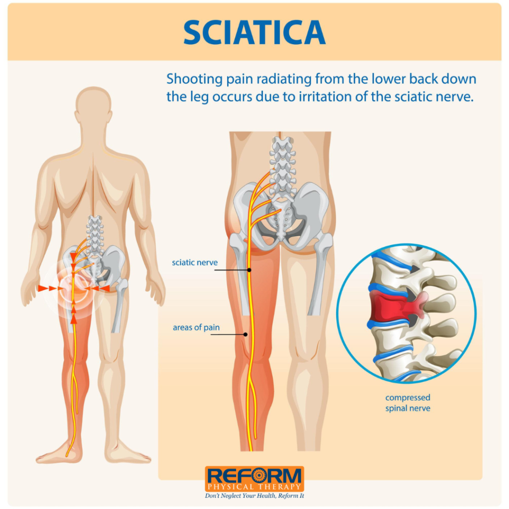 Illustration showing how sciatica or tight muscles can affect the lower back and leg.