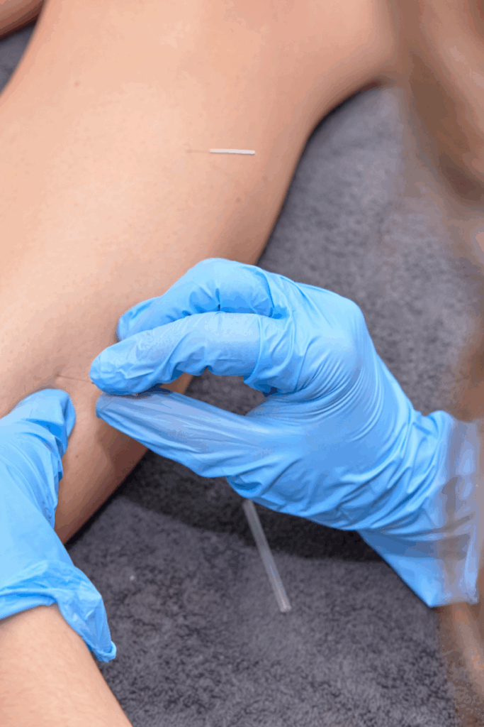 Dry needling Reform Physical Therapy